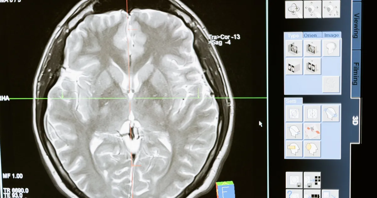 An MRI brain scan displayed on a computer screen
