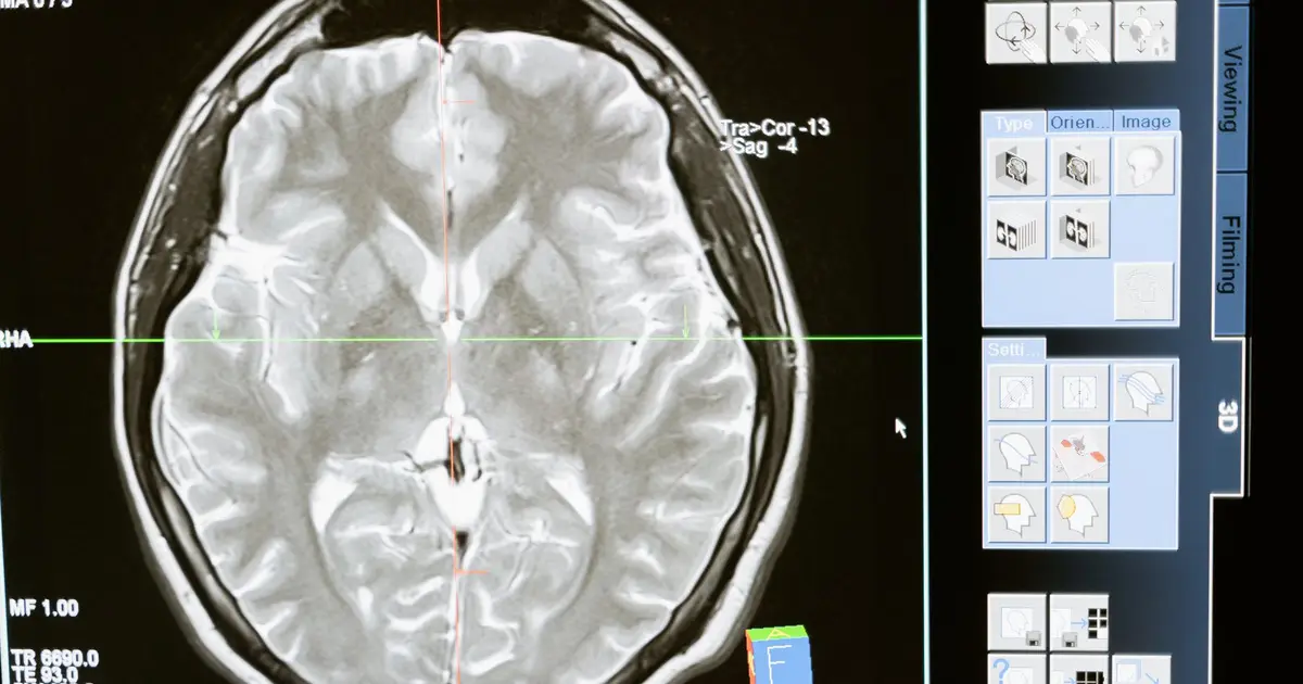 Intricate MRI brain scan displayed on a computer screen for medical analysis and diagnosis