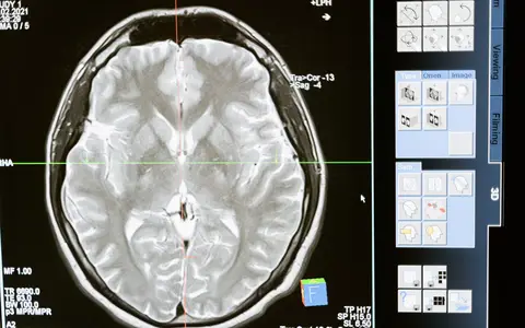 Intricate MRI brain scan displayed on a computer screen for medical analysis and diagnosis