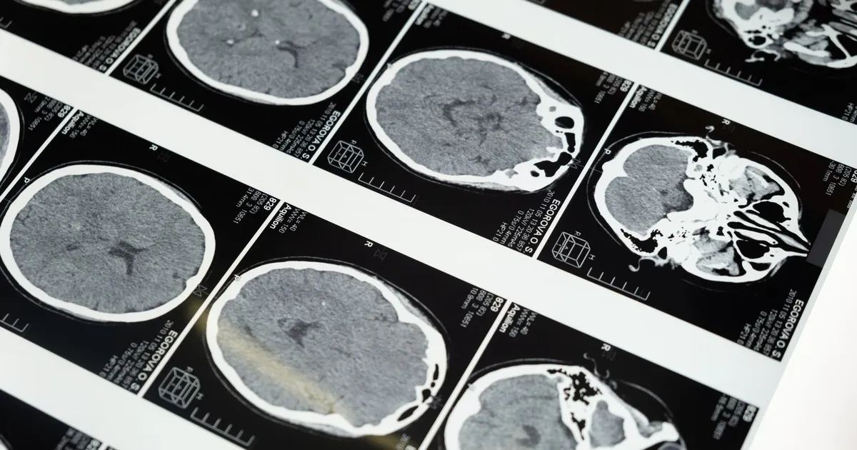 Brain MRI scans displayed on a lightbox